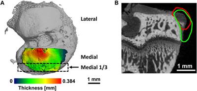 Intra-articular delivery of micronized dehydrated human amnion/chorion membrane reduces degenerative changes after onset of post-traumatic osteoarthritis
